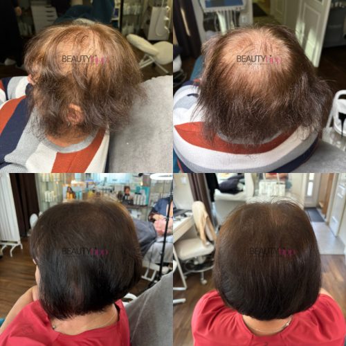 TCR Laser Hair Treatment + - professzionális lézeres hajterápia készülék ampullával 1db